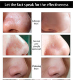 Nose Blackhead Remover